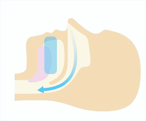佐賀市の歯医者、佐賀ん歯科・こども歯科で睡眠時無呼吸症候群の治療