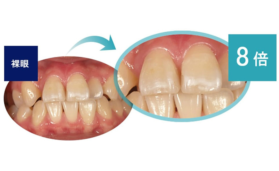 佐賀市の「佐賀ん歯科・こども歯科」は長持ちする精密治療をおこないます