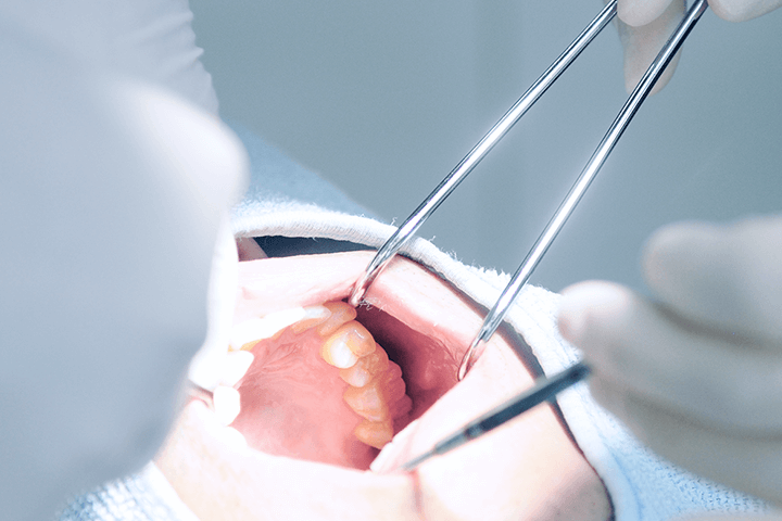 佐賀市の歯医者、佐賀ん歯科・こども歯科で親知らずの抜歯